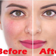 Illustration for article titled how to clear acne overnight